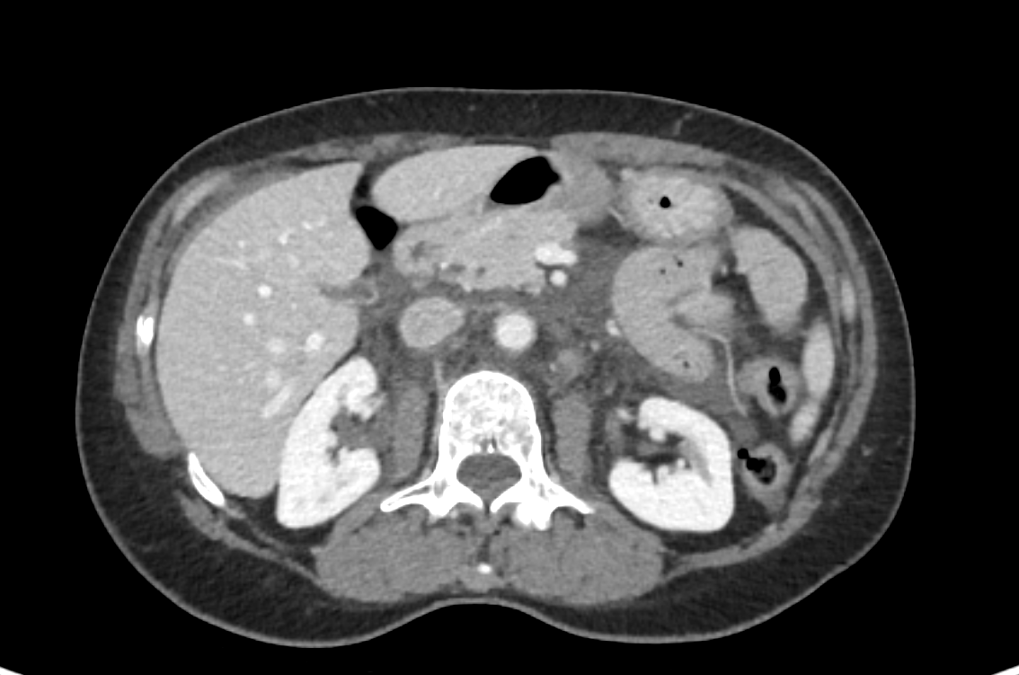 A 59yearold woman with right lower quadrant pain Auntminnie